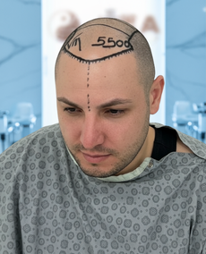 Sapphire FUE saç ekimi planlama aşaması